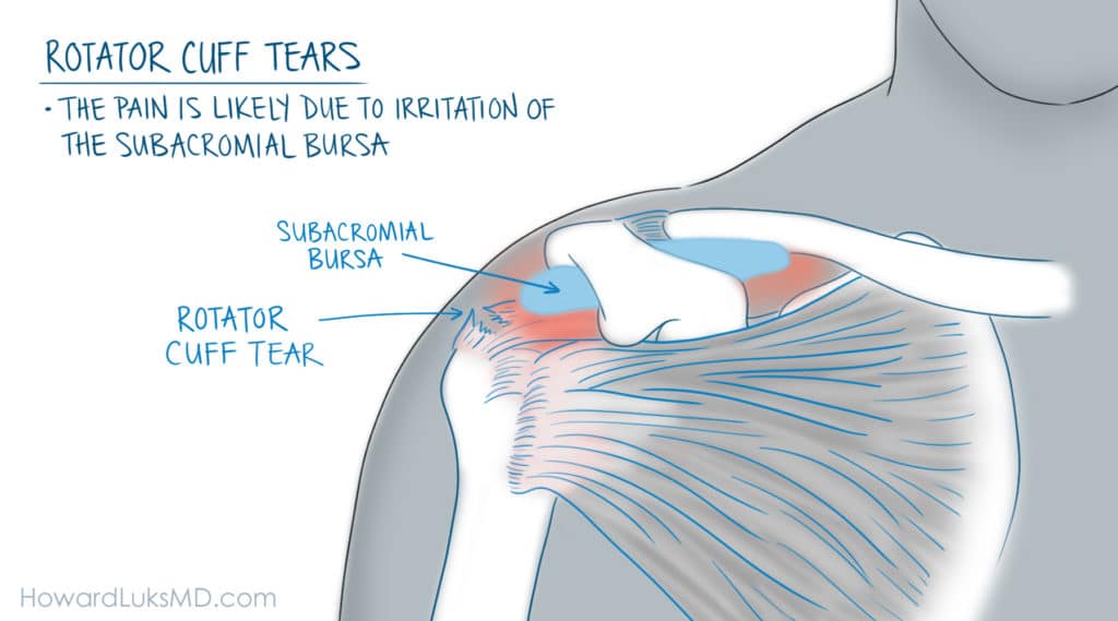 Rotator Cuff Tears and Shoulder Pain at Night