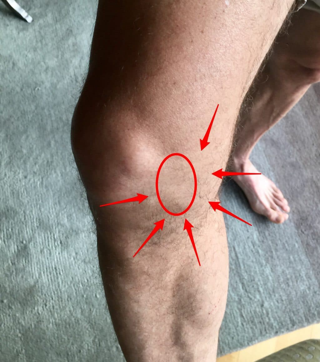 arthritis in one knee        <h3 class=