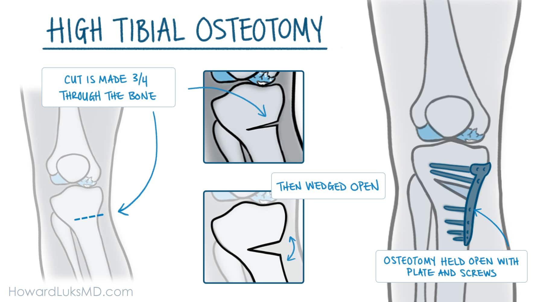 High Tibial Osteotomy For Knee Arthritis Pain In Active People