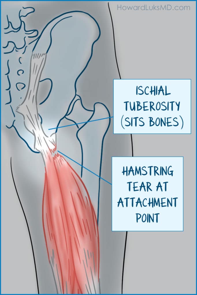 PSA🔔 Yoga butt, or proximal hamstring tendinopathy refers to the