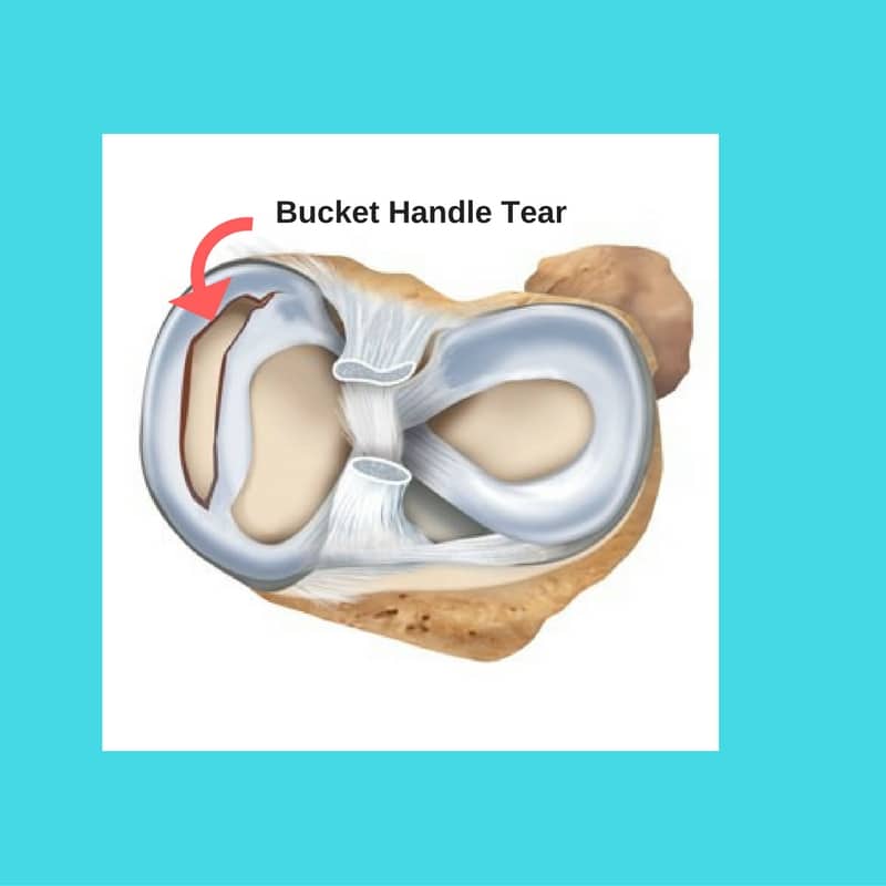 bucket handle fracture