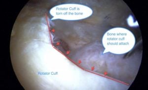 Rotator Cuff Healing : 4 Key Facts to 