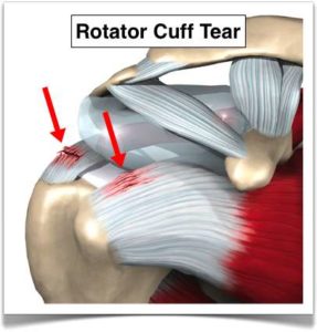 small rotator cuff tear