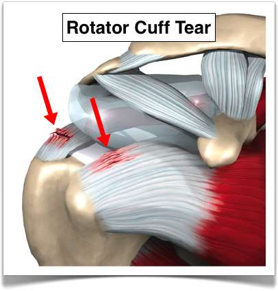 right rotator cuff injury