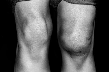 knee inflammation swelling